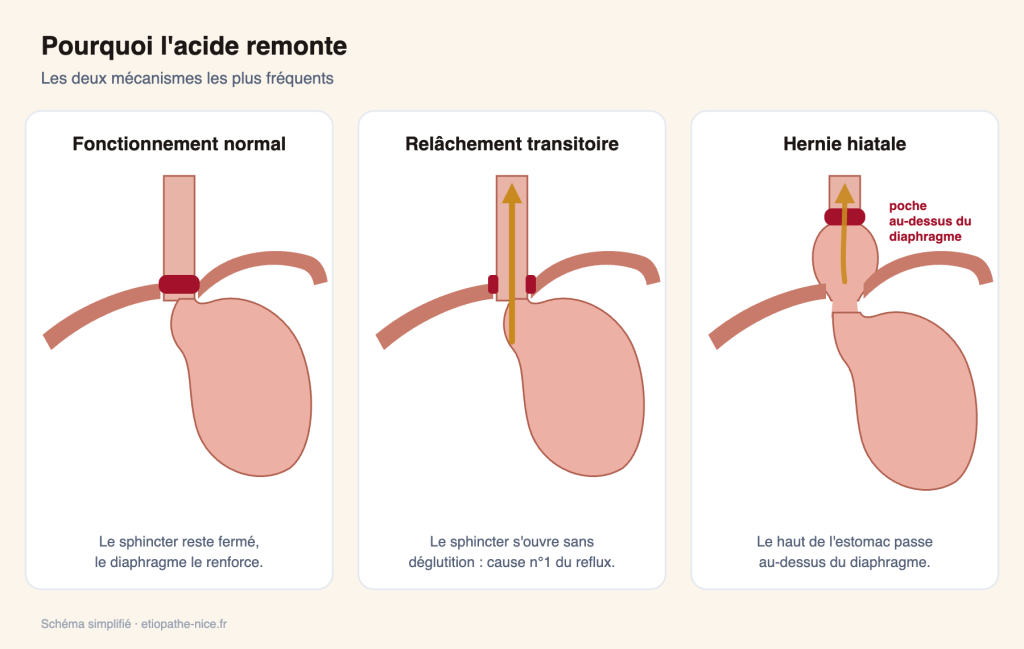 Schéma des mécanismes du reflux : relâchement transitoire du sphincter et hernie hiatale