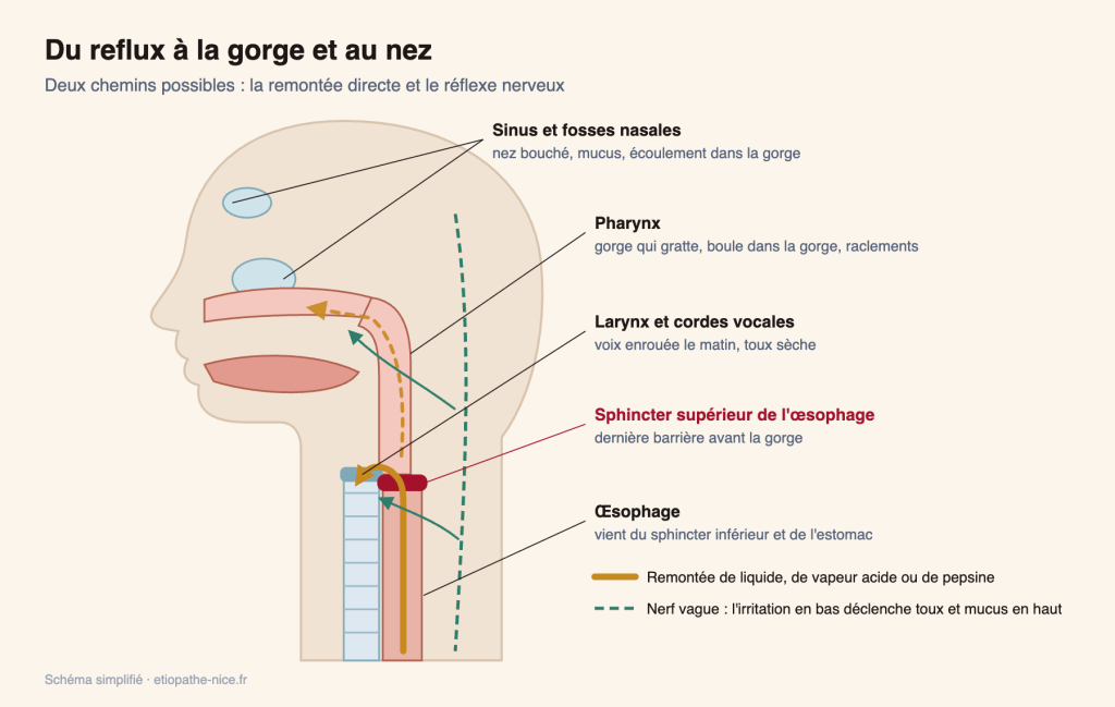 Schéma du reflux vers la gorge et le nez : sphincter supérieur de l'œsophage, larynx, pharynx, sinus et nerf vague